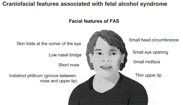 Fetales Alkoholsyndrom