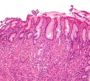 Gastritis helicobacter