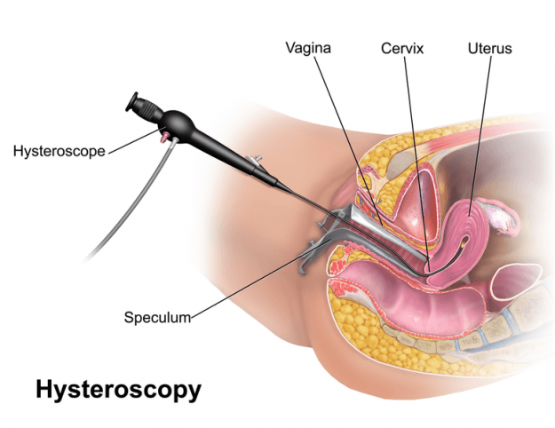 Hysteroskopie