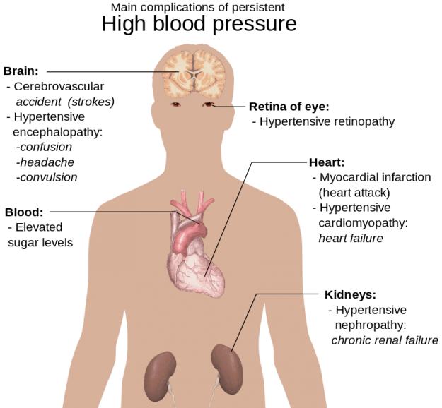 Komplikationen von Bluthochdruck