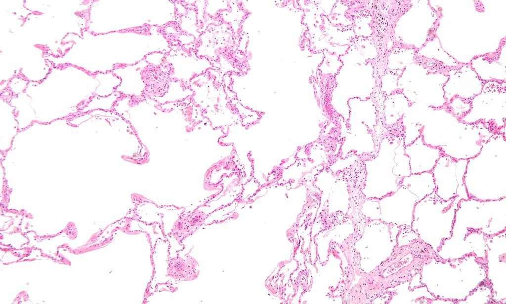Micrograph showing emphysema (left – large empty spaces) and lung tissue with relative preservation of the alveoli (right).