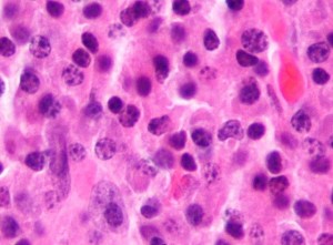 Plasmazytom-histologie
