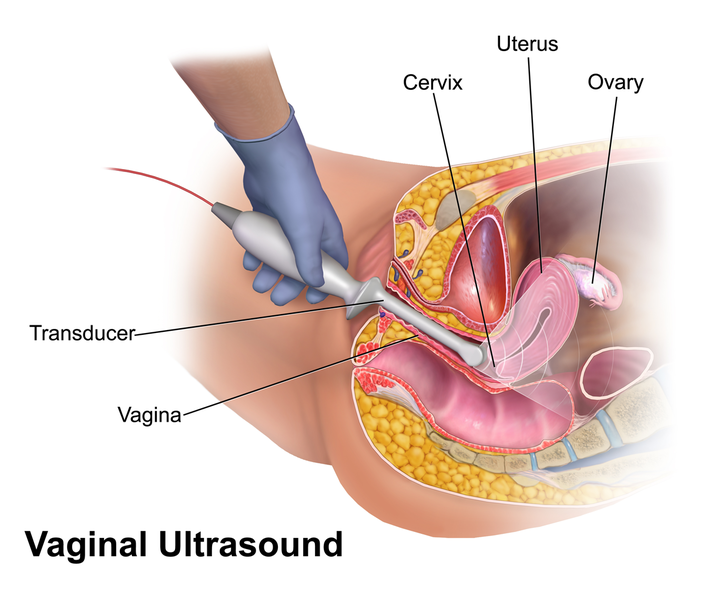 Vaginale Sonographie