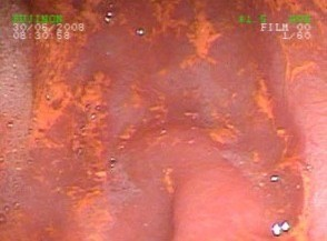Endoscopy appearance of the gastric antrum with discoloration after bromazepam intake.