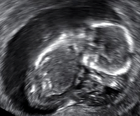 dieser ultraschall zeigt eine missed abortion