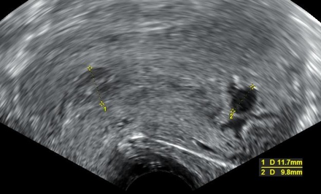 dieser ultraschall zeigt eine unvollstaendige fehlgeburt