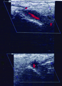 duplex-sonografie