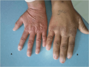 hand-akromegalie-patientin-im-vergleich
