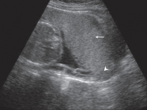 plazenta-praevia-ultraschallbild