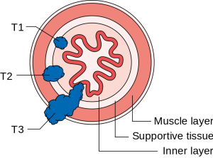 stadien-oesophaguskarzinom