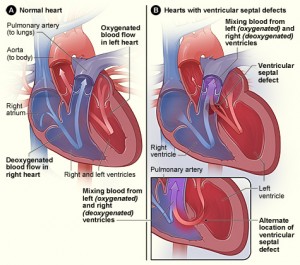 ventrikelseptumdefekt