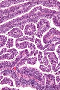 Adenokarzinom-histologisch