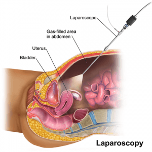 Laparoskopie