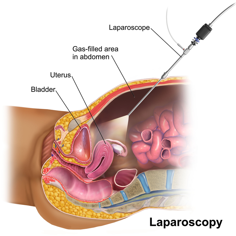 Laparoskopiegroß