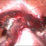 laparoskopische-Hysterektomie