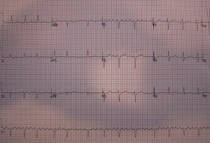 vorhofflattern-EKG