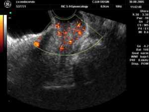 zervixkarzinom-im-doppler-ultraschal