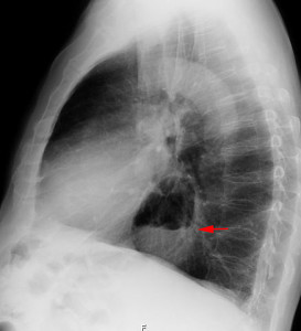Hiatushernie im seitlichen Röntgenbild des Thorax