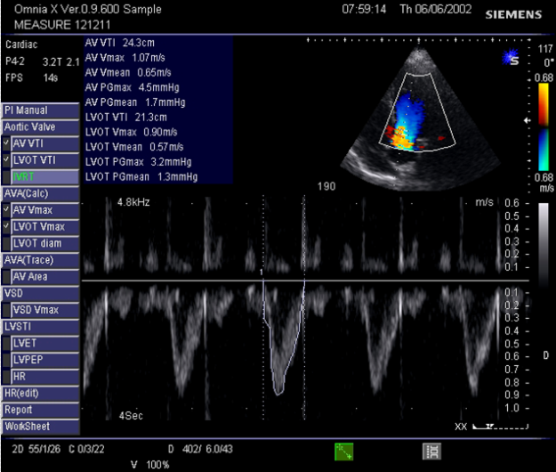 Umfahrung des PW-Doppler-Signals im LVOT: Velocity Time Integral (VTI)