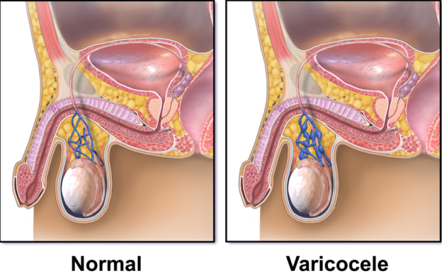 Varicocele (Scrotum Varicose Veins) — Diagnosis and Treatment ...