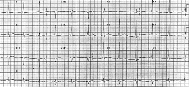 12 lead EKG demonstrating Wolff-Parkinson-White syndrome 12 lead EKG demonstrating Wolff-Parkinson-White syndrome