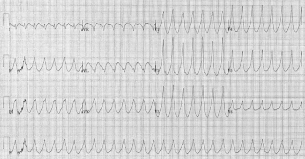12 lead electrocardiogram of a ventricular tachycardia