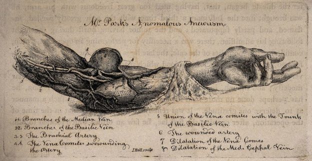 A dissected arm showing arteries