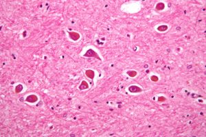 alzheimer type 2 astrocyte