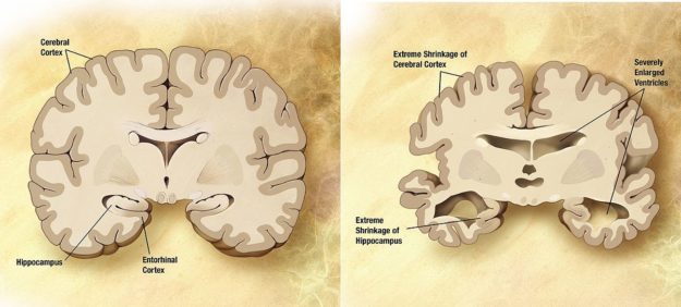 alzheimers disease brain comparison