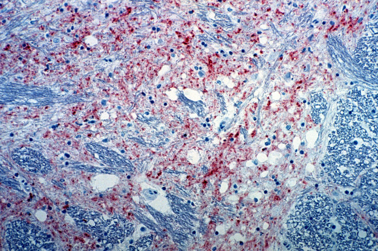 Mad cow disease or bovine spongiform encephalopathy BSE