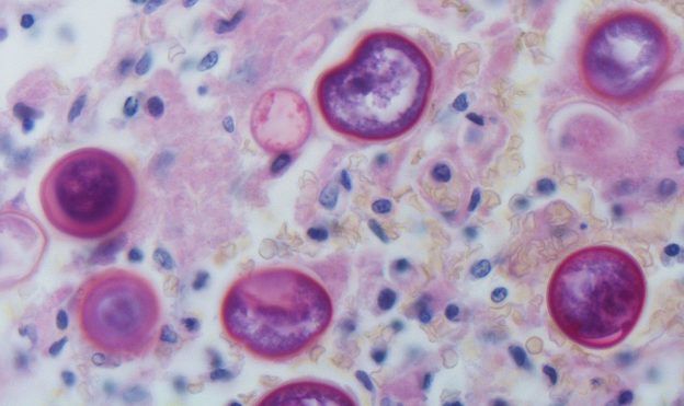 coccidioidomycosis mostly mature spherules of coccidioides containing endospores