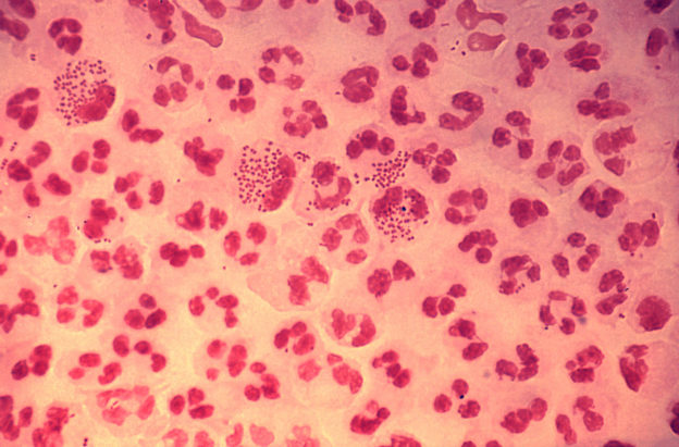 Gonococcal urethritis