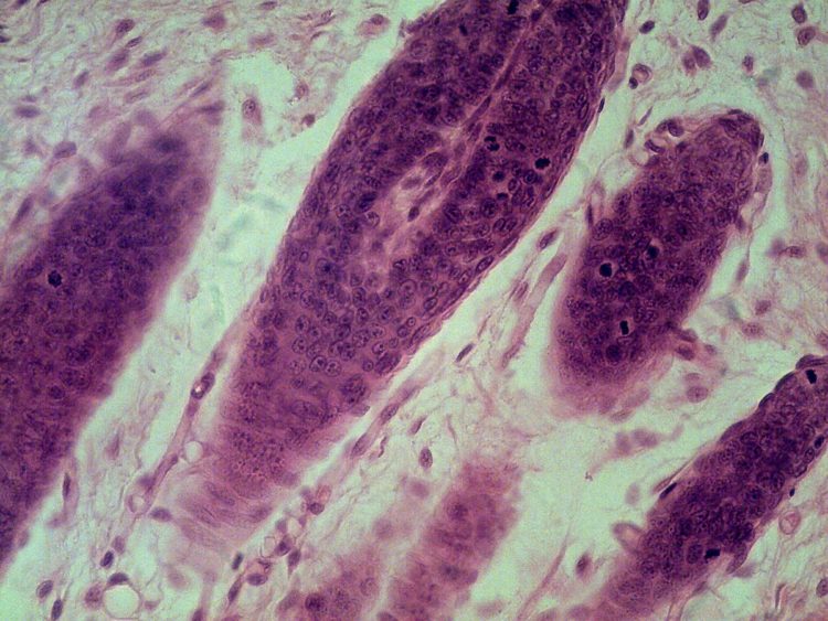 Folliculitis (Inflammation of Hair Follicles) — Symptoms and Treatment