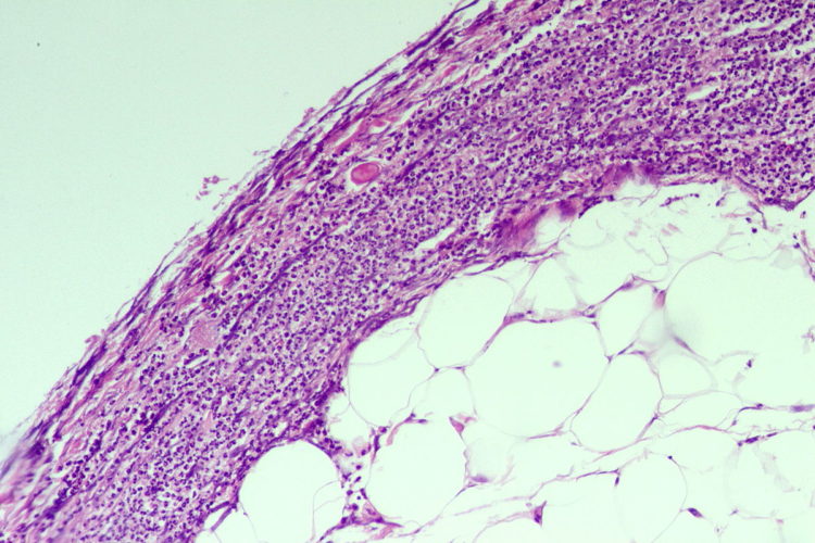 Ischemic Colitis — Physical Examination and Diagnosis Medical Library