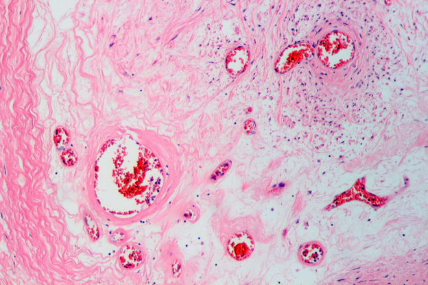 Occluded artery in peripheral vascular disease