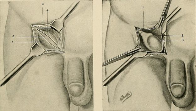 surgery undescended testicle