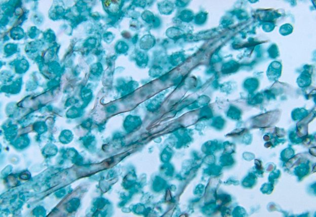 Zygomycosis caused by mucor pusillus