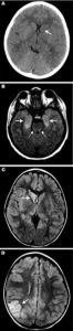 Eastern equine encephalitis head scans