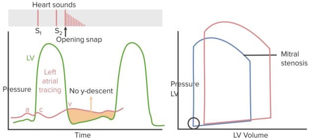 mitral-stenosis