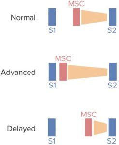 Mitral-valve-prolapse
