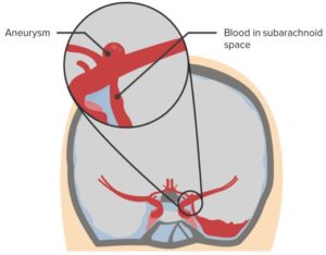 Subarachnoid-Hemorrhage1