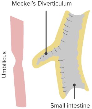 Meckel´s-Diverticulum