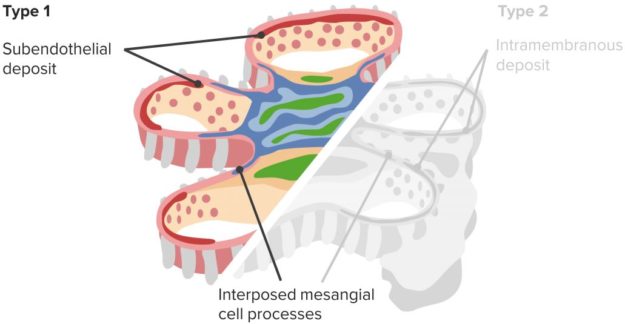 Membranoproliferative-Glomerulonephritis