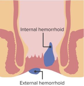 Hemorrhoids1