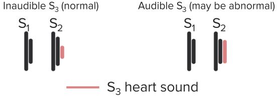 Heart-Sound-S3