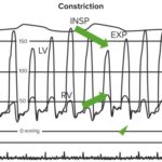 Constrictive Pericarditis — Symptoms and ECG | Medical Library