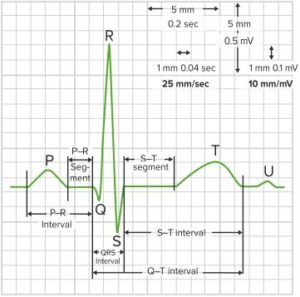 Arrhythmia (Irregular Heartbeat) — Classification and Types