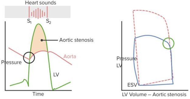 Heart-Sounds-Aortic-Stenosis