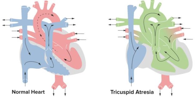 Tricuspid-Atresia