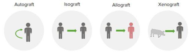 Classification-of-Transplantation